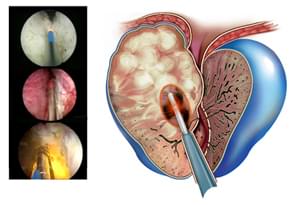 Современное лечение предстательной железы с помощью тулиевого лазера